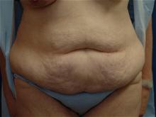 Tummy Tuck Before Photo by Ellen Janetzke, MD; Bloomfield Hills, MI - Case 27519
