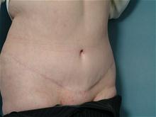 Tummy Tuck After Photo by Ellen Janetzke, MD; Bloomfield Hills, MI - Case 27519