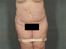 Tummy Tuck After Photo by Ellen Janetzke, MD; Bloomfield Hills, MI - Case 27520