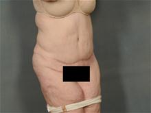 Tummy Tuck After Photo by Ellen Janetzke, MD; Bloomfield Hills, MI - Case 27520