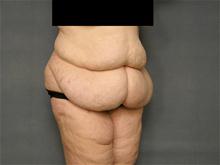 Tummy Tuck Before Photo by Ellen Janetzke, MD; Bloomfield Hills, MI - Case 27520