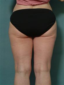 Liposuction After Photo by Ellen Janetzke, MD; Bloomfield Hills, MI - Case 27521