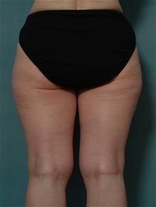 Liposuction Before Photo by Ellen Janetzke, MD; Bloomfield Hills, MI - Case 27521