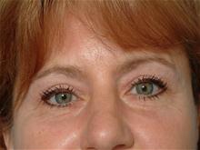 Eyelid Surgery After Photo by Ellen Janetzke, MD; Bloomfield Hills, MI - Case 27522