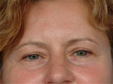 Eyelid Surgery Before Photo by Ellen Janetzke, MD; Bloomfield Hills, MI - Case 27522