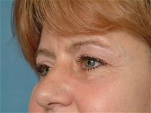 Eyelid Surgery After Photo by Ellen Janetzke, MD; Bloomfield Hills, MI - Case 27522