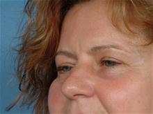 Eyelid Surgery Before Photo by Ellen Janetzke, MD; Bloomfield Hills, MI - Case 27522