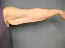 Arm Lift Before Photo by Ellen Janetzke, MD; Bloomfield Hills, MI - Case 27523