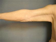 Arm Lift After Photo by Ellen Janetzke, MD; Bloomfield Hills, MI - Case 27523