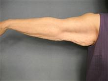 Arm Lift Before Photo by Ellen Janetzke, MD; Bloomfield Hills, MI - Case 27523