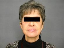 Facelift After Photo by Ellen Janetzke, MD; Bloomfield Hills, MI - Case 27526