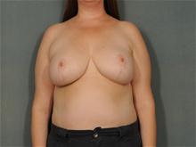 Breast Reduction After Photo by Ellen Janetzke, MD; Bloomfield Hills, MI - Case 27626