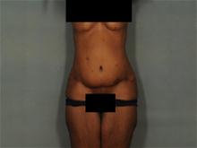 Tummy Tuck After Photo by Ellen Janetzke, MD; Bloomfield Hills, MI - Case 27649