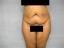 Tummy Tuck Before Photo by Ellen Janetzke, MD; Bloomfield Hills, MI - Case 27649