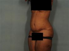 Tummy Tuck After Photo by Ellen Janetzke, MD; Bloomfield Hills, MI - Case 27649