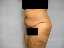 Tummy Tuck Before Photo by Ellen Janetzke, MD; Bloomfield Hills, MI - Case 27649
