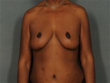 Breast Reduction After Photo by Ellen Janetzke, MD; Bloomfield Hills, MI - Case 27650