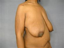 Breast Reduction Before Photo by Ellen Janetzke, MD; Bloomfield Hills, MI - Case 27650