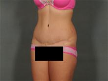 Tummy Tuck After Photo by Ellen Janetzke, MD; Bloomfield Hills, MI - Case 27793