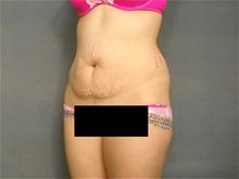 Tummy Tuck Before Photo by Ellen Janetzke, MD; Bloomfield Hills, MI - Case 27793
