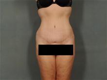Tummy Tuck After Photo by Ellen Janetzke, MD; Bloomfield Hills, MI - Case 27826