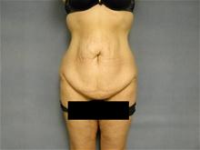 Tummy Tuck Before Photo by Ellen Janetzke, MD; Bloomfield Hills, MI - Case 27826