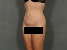 Tummy Tuck After Photo by Ellen Janetzke, MD; Bloomfield Hills, MI - Case 27826