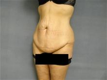 Tummy Tuck Before Photo by Ellen Janetzke, MD; Bloomfield Hills, MI - Case 27826