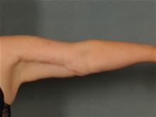 Arm Lift After Photo by Ellen Janetzke, MD; Bloomfield Hills, MI - Case 27827