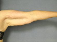 Arm Lift Before Photo by Ellen Janetzke, MD; Bloomfield Hills, MI - Case 27827