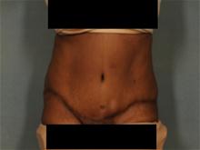 Tummy Tuck After Photo by Ellen Janetzke, MD; Bloomfield Hills, MI - Case 27855