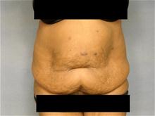 Tummy Tuck Before Photo by Ellen Janetzke, MD; Bloomfield Hills, MI - Case 27855
