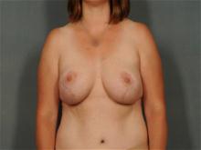 Breast Reduction After Photo by Ellen Janetzke, MD; Bloomfield Hills, MI - Case 27948