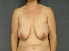 Breast Reduction Before Photo by Ellen Janetzke, MD; Bloomfield Hills, MI - Case 27948