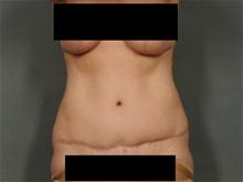 Tummy Tuck After Photo by Ellen Janetzke, MD; Bloomfield Hills, MI - Case 27949
