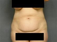 Tummy Tuck Before Photo by Ellen Janetzke, MD; Bloomfield Hills, MI - Case 27949