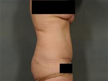 Tummy Tuck After Photo by Ellen Janetzke, MD; Bloomfield Hills, MI - Case 27949