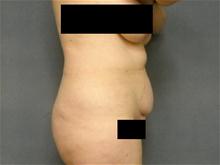 Tummy Tuck Before Photo by Ellen Janetzke, MD; Bloomfield Hills, MI - Case 27949