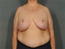Breast Reduction After Photo by Ellen Janetzke, MD; Bloomfield Hills, MI - Case 27950