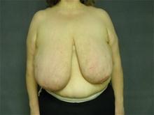 Breast Reduction Before Photo by Ellen Janetzke, MD; Bloomfield Hills, MI - Case 27950