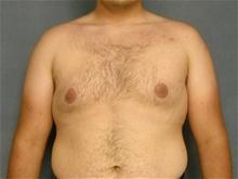 Male Breast Reduction Before Photo by Ellen Janetzke, MD; Bloomfield Hills, MI - Case 27951