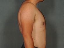 Male Breast Reduction After Photo by Ellen Janetzke, MD; Bloomfield Hills, MI - Case 27951
