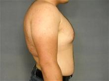 Male Breast Reduction Before Photo by Ellen Janetzke, MD; Bloomfield Hills, MI - Case 27951