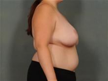 Breast Reduction After Photo by Ellen Janetzke, MD; Bloomfield Hills, MI - Case 28042