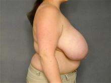 Breast Reduction Before Photo by Ellen Janetzke, MD; Bloomfield Hills, MI - Case 28042