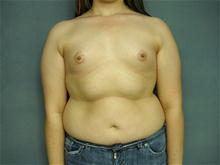 Breast Augmentation Before Photo by Ellen Janetzke, MD; Bloomfield Hills, MI - Case 28043