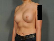 Breast Augmentation After Photo by Ellen Janetzke, MD; Bloomfield Hills, MI - Case 28043