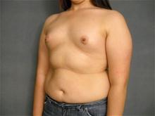 Breast Augmentation Before Photo by Ellen Janetzke, MD; Bloomfield Hills, MI - Case 28043