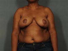 Breast Reduction After Photo by Ellen Janetzke, MD; Bloomfield Hills, MI - Case 28048