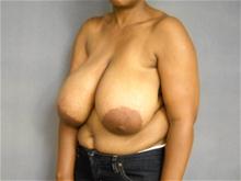 Breast Reduction Before Photo by Ellen Janetzke, MD; Bloomfield Hills, MI - Case 28048